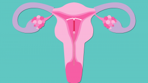 IUD in womb